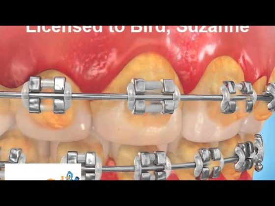 Decalcification with Braces thumbnail