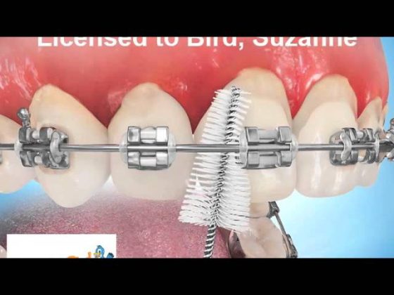 How to Use a ProxyBrush with Braces thumbnail