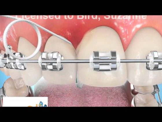 How to Use a Superfloss with Braces thumbnail