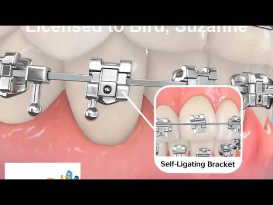 Parts of Braces thumbnail